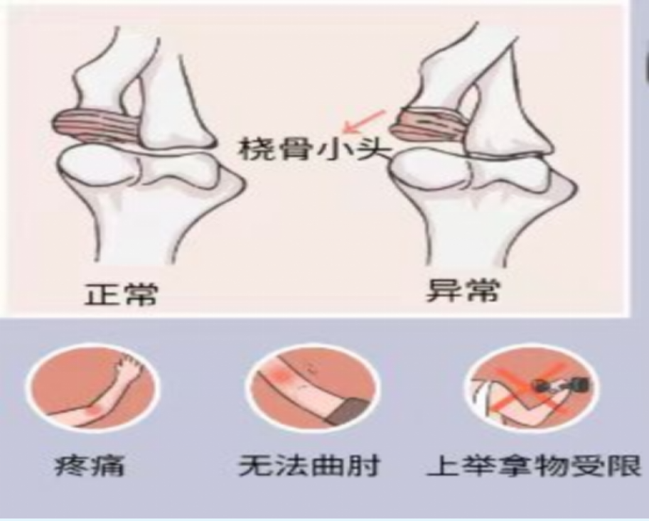 【康医科普】桡骨小头半脱位