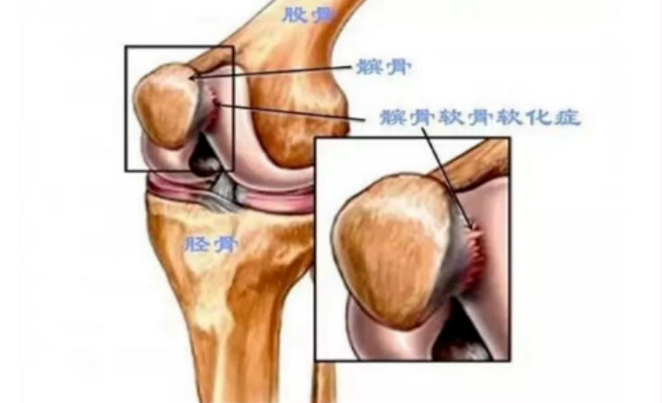 【康医科普】得了髌骨软化症？试试PRP治疗