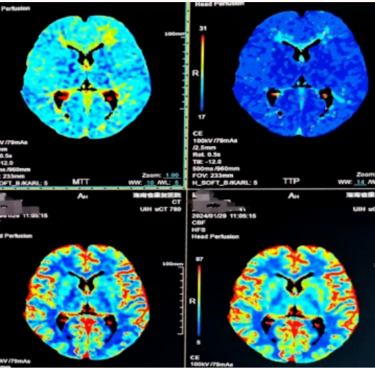 【康医科普】脑灌注成像（CTP）让医生更了解你的脑