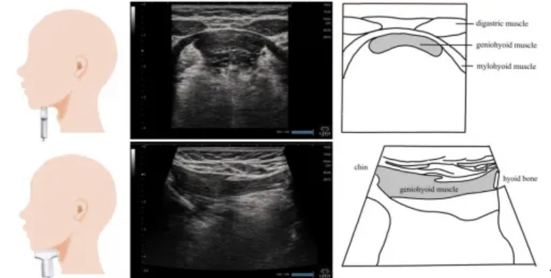 【文献速递】进食和吞咽评估的超声检查